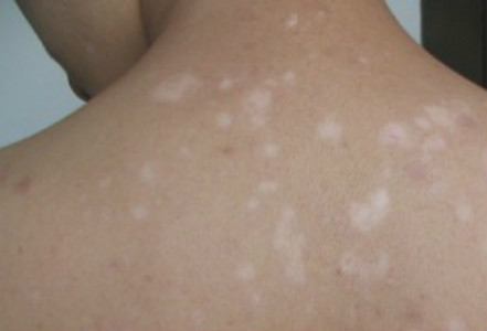 怎样科学诊断白癜风疾病